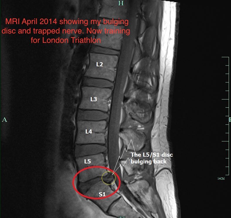 bulging disc at l5