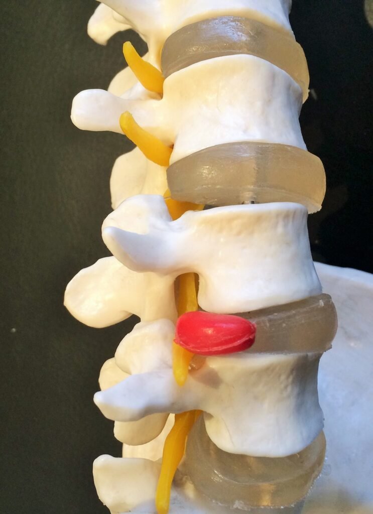Spine model showing a lumbar disc bulge pressing on a nerve root
