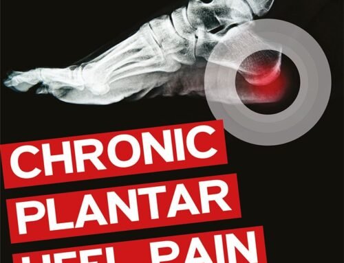 Foot and Heel Pain Physio for Hampstead Garden Suburb, Golders Green and Temple Fortune