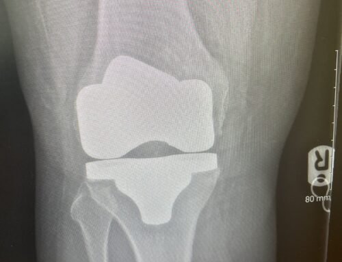 Knee Replacement Recovery: Both Knees, Three Months Apart