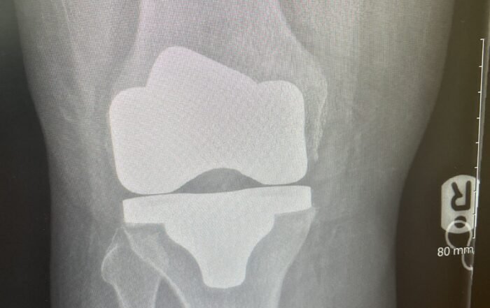 Total knee replacement rehab